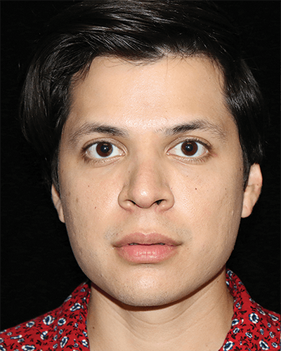 Facial Fat Grafting Before & After Gallery - Patient 387763 - Image 1
