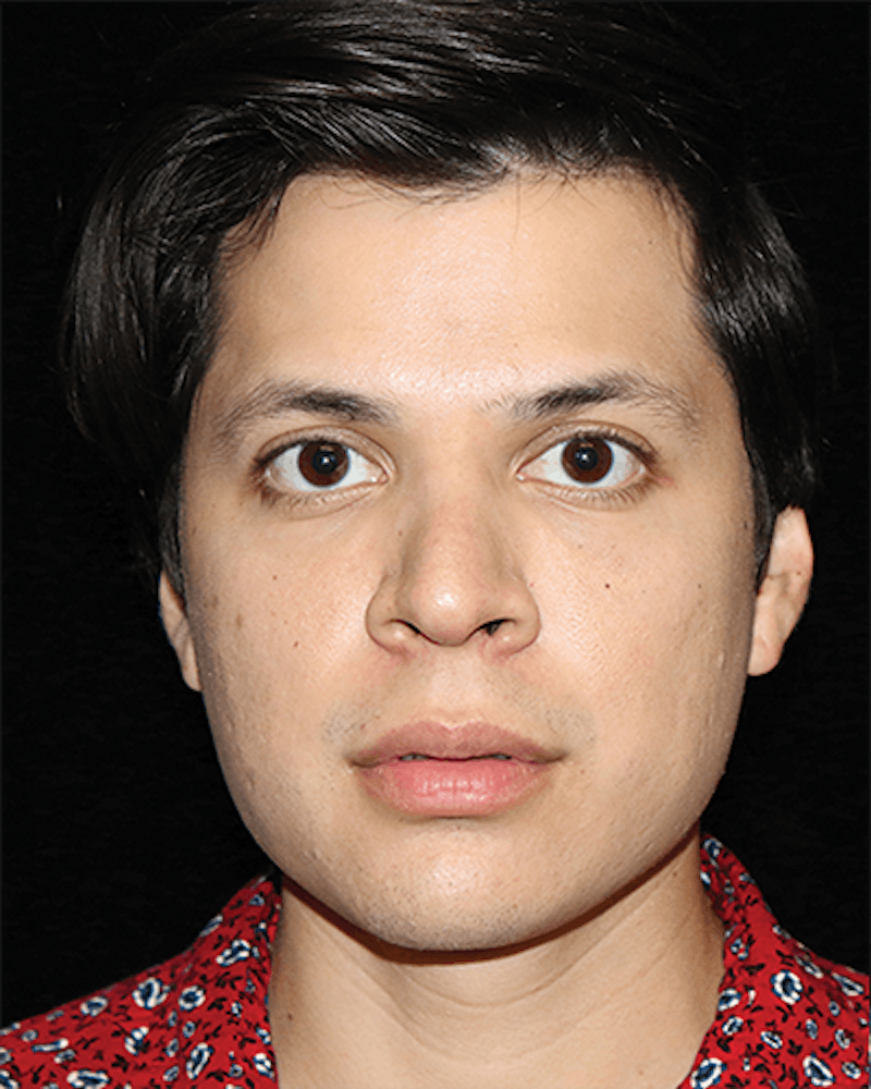 Facial Fat Grafting Before & After Gallery - Patient 387763 - Image 1