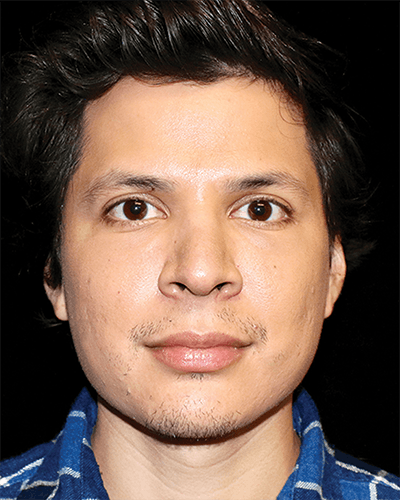 Facial Fat Grafting Before & After Gallery - Patient 387763 - Image 2