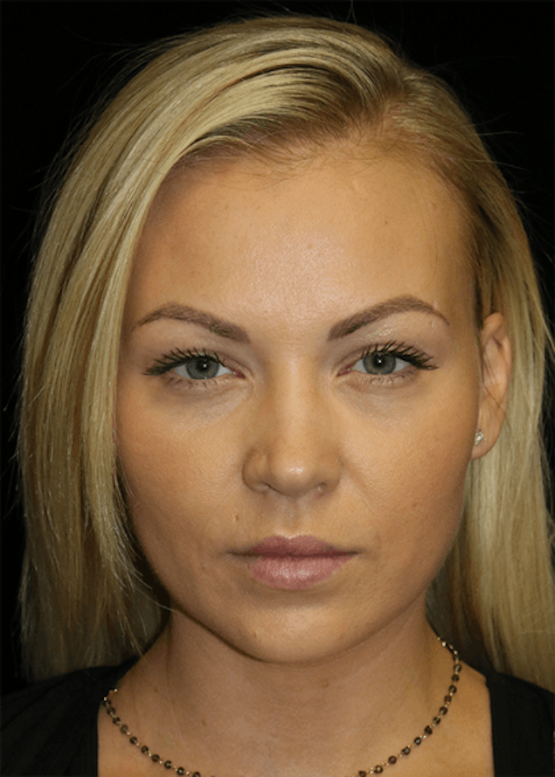 Facial Fat Grafting Before & After Gallery - Patient 391156 - Image 1