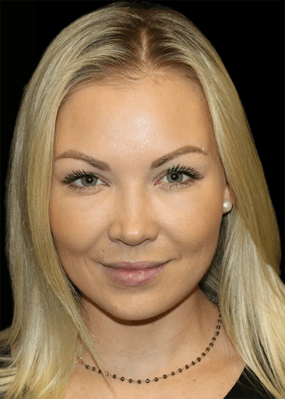 Facial Fat Grafting Before & After Gallery - Patient 391156 - Image 2