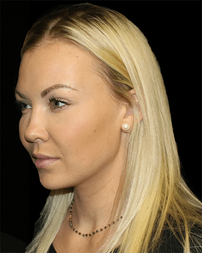 Facial Fat Grafting Before & After Gallery - Patient 391156 - Image 4