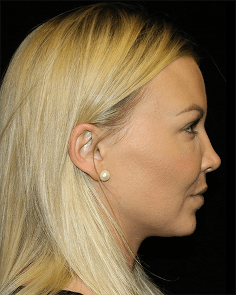 Facial Fat Grafting Before & After Gallery - Patient 391156 - Image 6