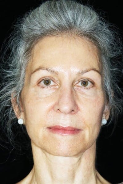 Mini Facelift Before & After Gallery - Patient 537112 - Image 1