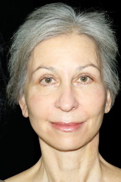 Mini Facelift Before & After Gallery - Patient 537112 - Image 2