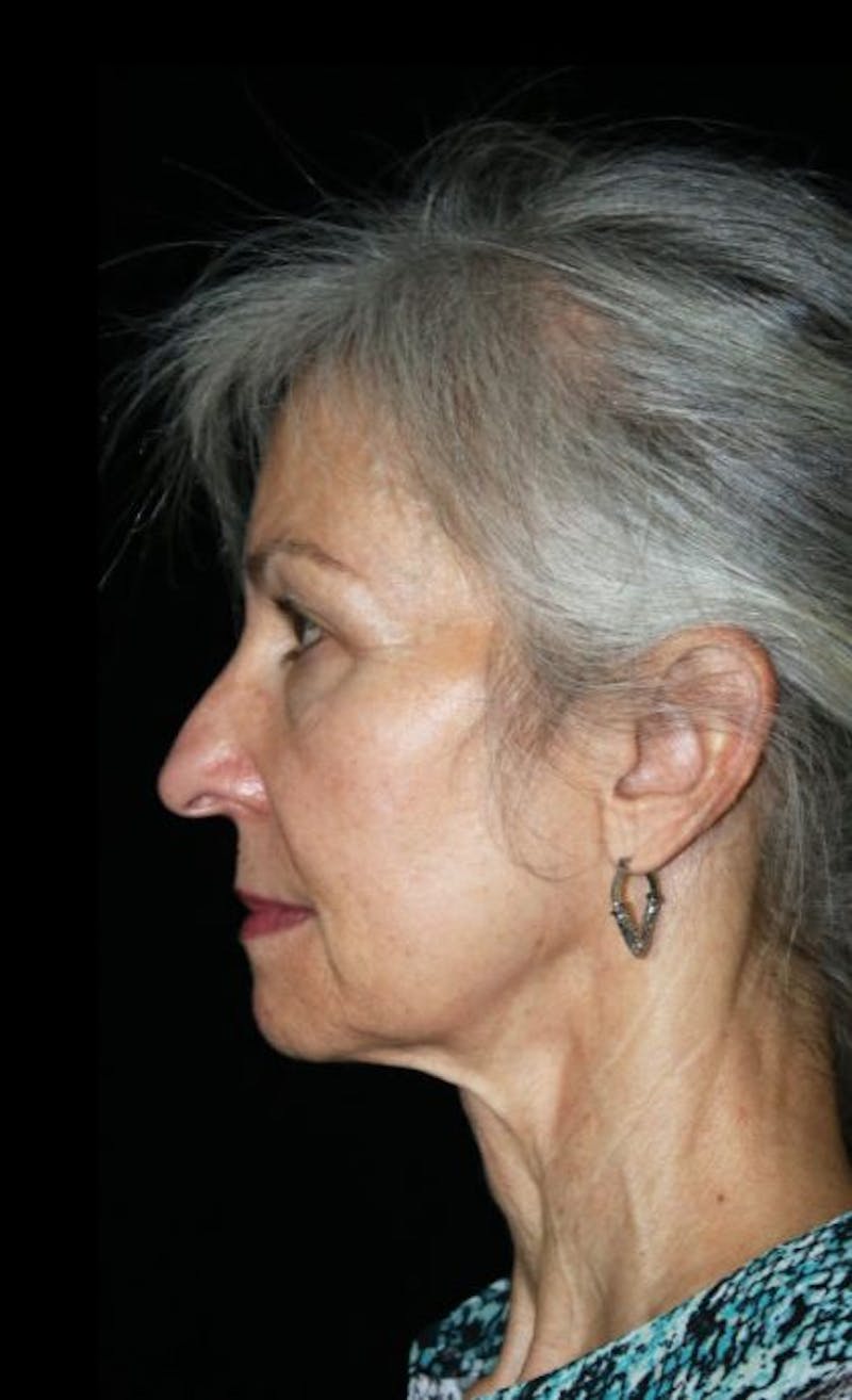 Mini Facelift Before & After Gallery - Patient 537112 - Image 3