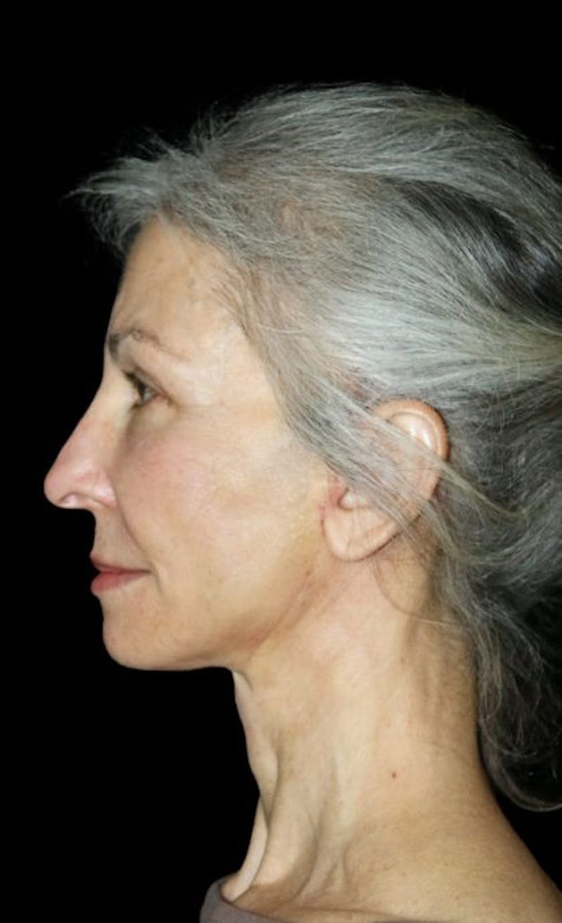 Mini Facelift Before & After Gallery - Patient 537112 - Image 4