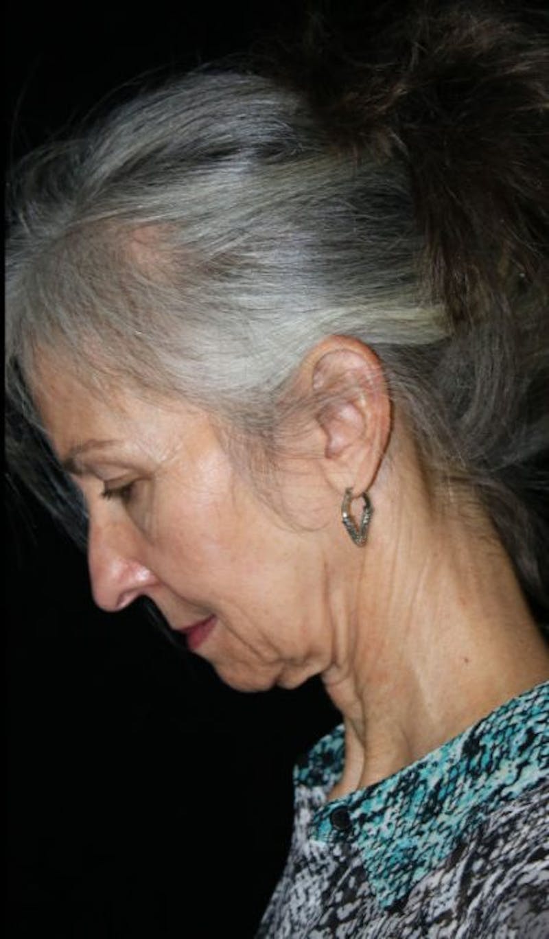 Mini Facelift Before & After Gallery - Patient 537112 - Image 5