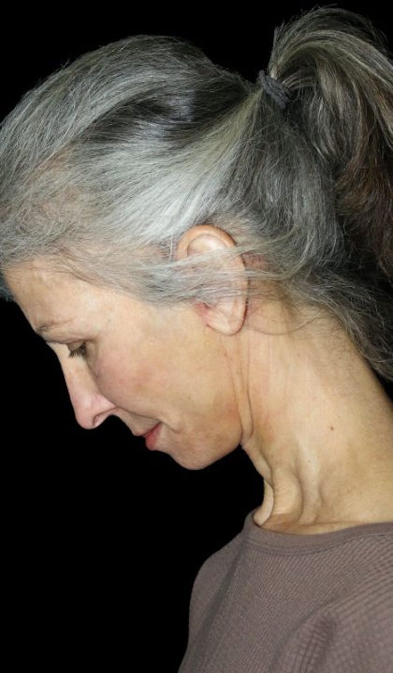 Mini Facelift Before & After Gallery - Patient 537112 - Image 6