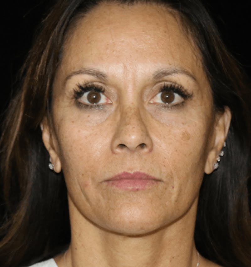 Mini Facelift Before & After Gallery - Patient 220891 - Image 3