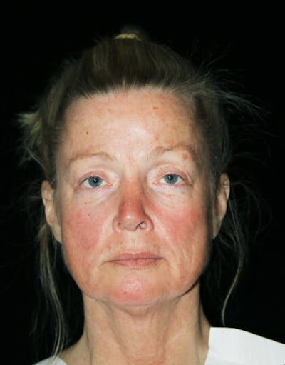 Mini Facelift Before & After Gallery - Patient 260632 - Image 1