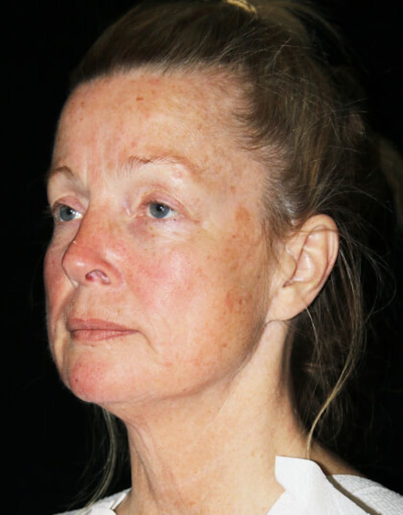 Mini Facelift Before & After Gallery - Patient 260632 - Image 3