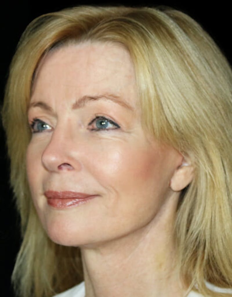 Mini Facelift Before & After Gallery - Patient 260632 - Image 4