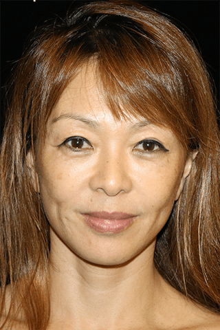 Mini Facelift Before & After Gallery - Patient 793459 - Image 2