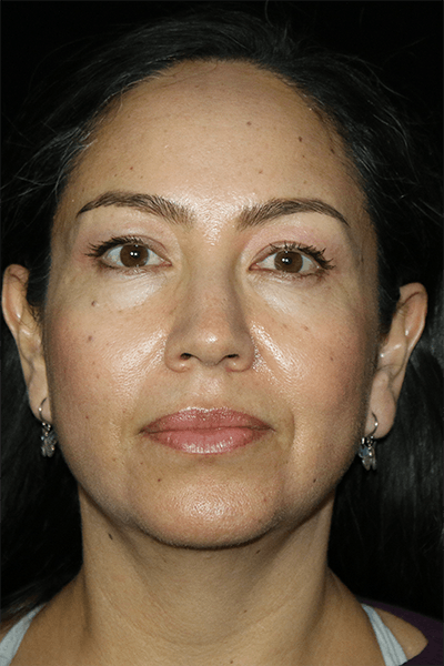 Mini Facelift Before & After Gallery - Patient 135907 - Image 1