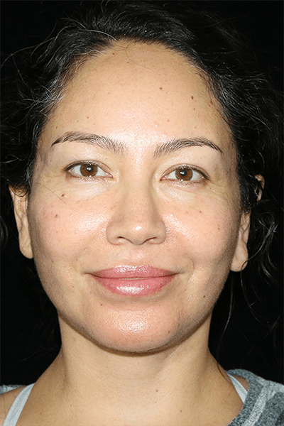 Mini Facelift Before & After Gallery - Patient 135907 - Image 2