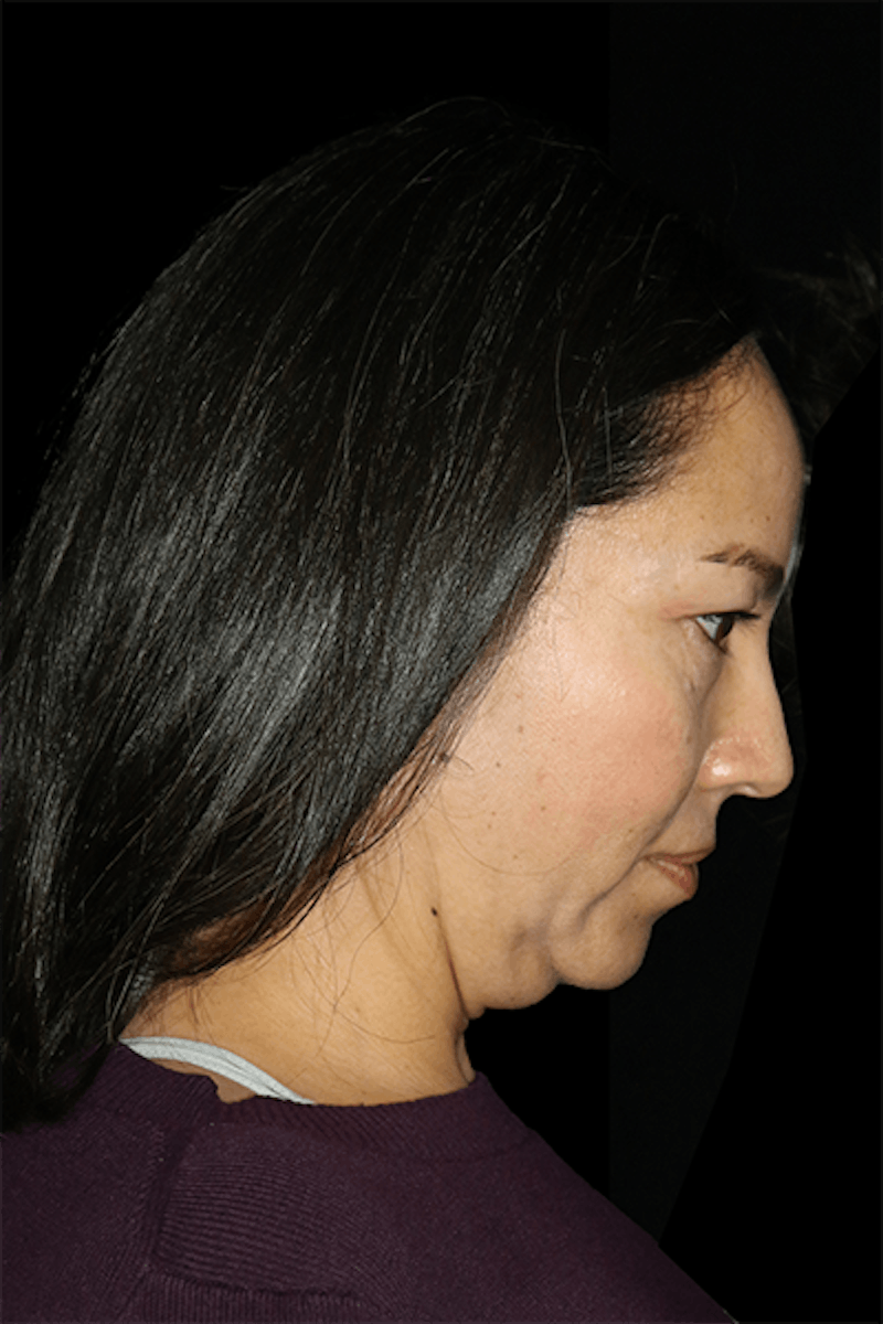 Mini Facelift Before & After Gallery - Patient 135907 - Image 3