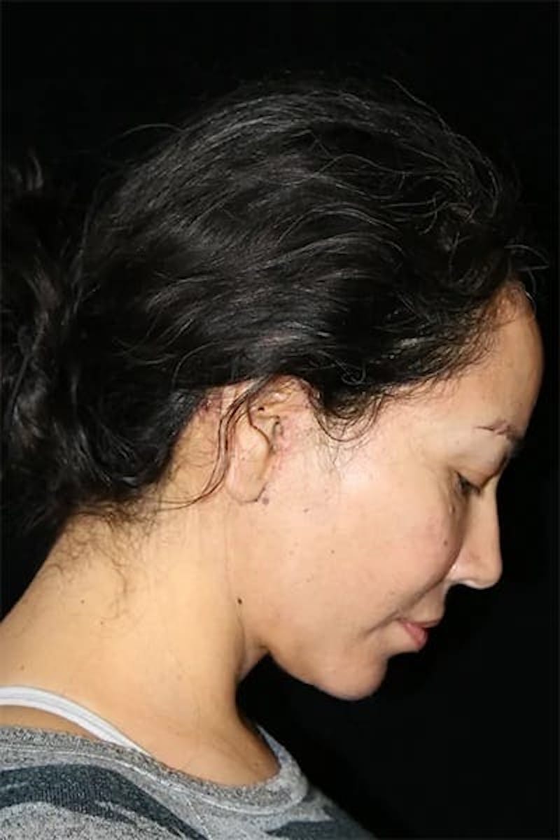 Mini Facelift Before & After Gallery - Patient 135907 - Image 4