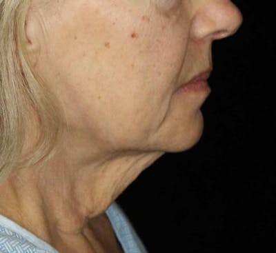 Neck Lift Before & After Gallery - Patient 341340 - Image 1