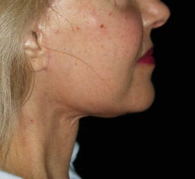 Neck Lift Before & After Gallery - Patient 341340 - Image 2
