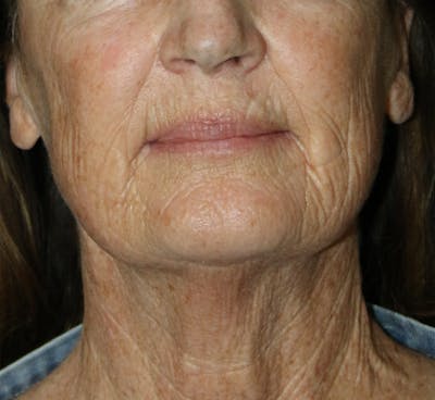 Neck Lift Before & After Gallery - Patient 364687 - Image 1