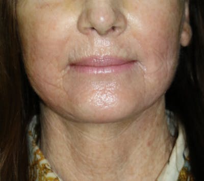 Neck Lift Before & After Gallery - Patient 364687 - Image 2