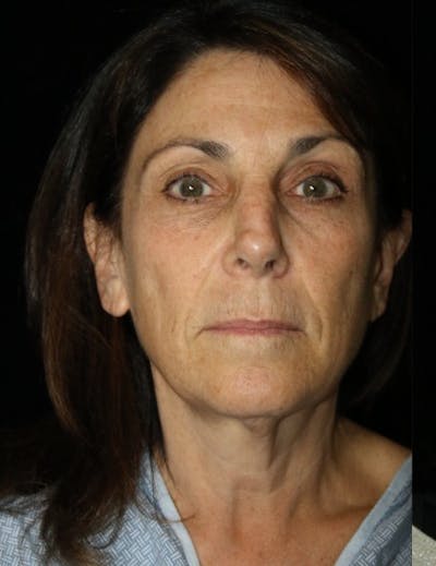 Blepharoplasty Before & After Gallery - Patient 472742 - Image 1