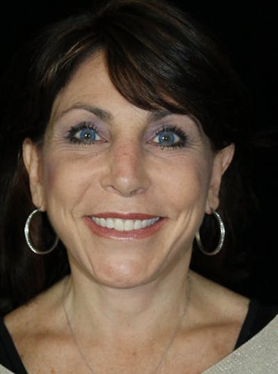 Blepharoplasty Before & After Gallery - Patient 472742 - Image 2