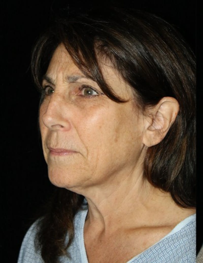 Blepharoplasty Before & After Gallery - Patient 472742 - Image 3