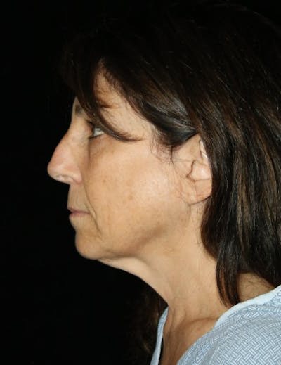 Neck Lift Before & After Gallery - Patient 172670 - Image 1