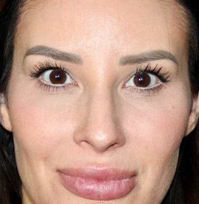 Blepharoplasty Before & After Gallery - Patient 130292 - Image 1