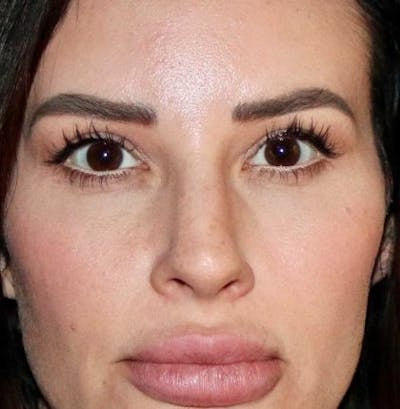 Blepharoplasty Before & After Gallery - Patient 130292 - Image 2