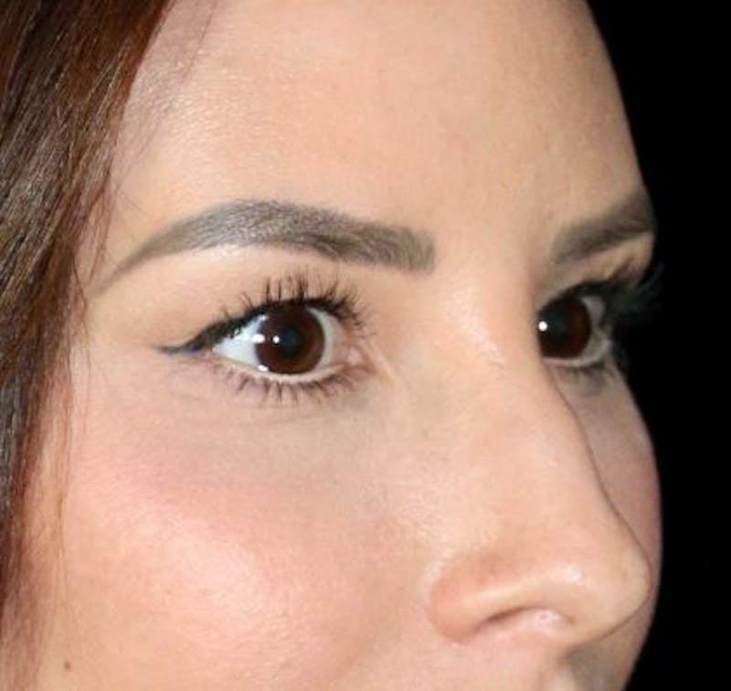 Blepharoplasty Before & After Gallery - Patient 130292 - Image 3