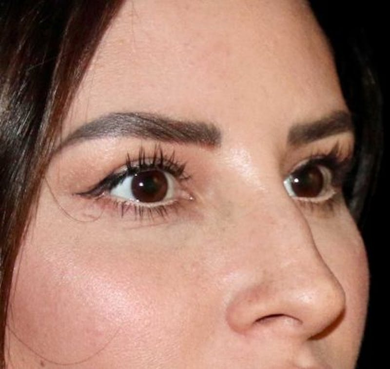 Blepharoplasty Before & After Gallery - Patient 130292 - Image 4