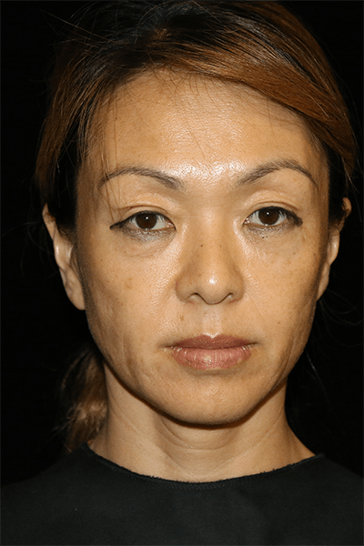 Blepharoplasty Before & After Gallery - Patient 285313 - Image 1