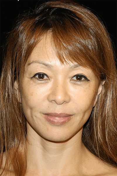 Blepharoplasty Before & After Gallery - Patient 285313 - Image 2