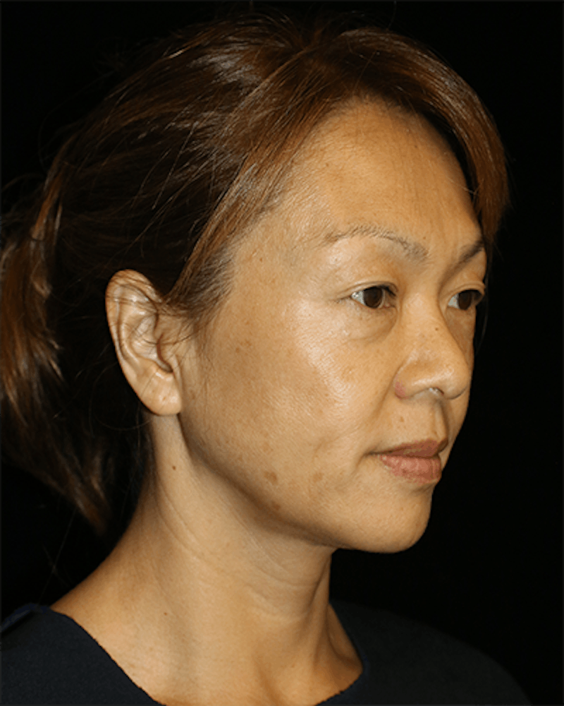 Blepharoplasty Before & After Gallery - Patient 285313 - Image 3