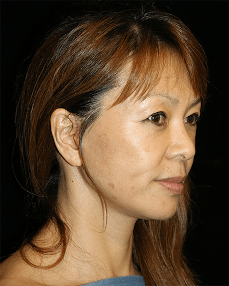 Blepharoplasty Before & After Gallery - Patient 285313 - Image 4