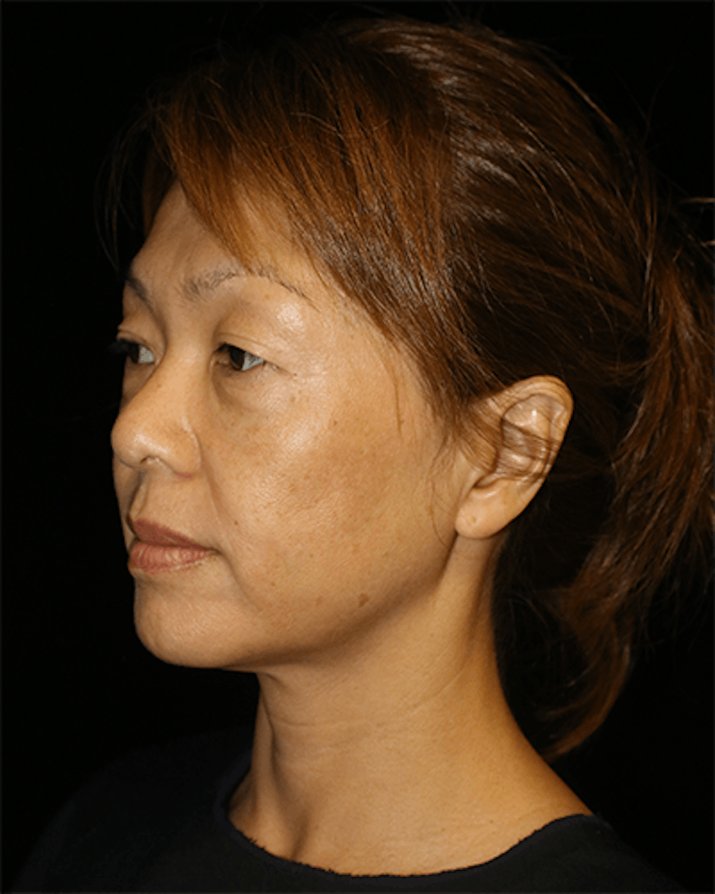 Blepharoplasty Before & After Gallery - Patient 285313 - Image 5