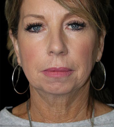 Blepharoplasty Before & After Gallery - Patient 112242 - Image 1