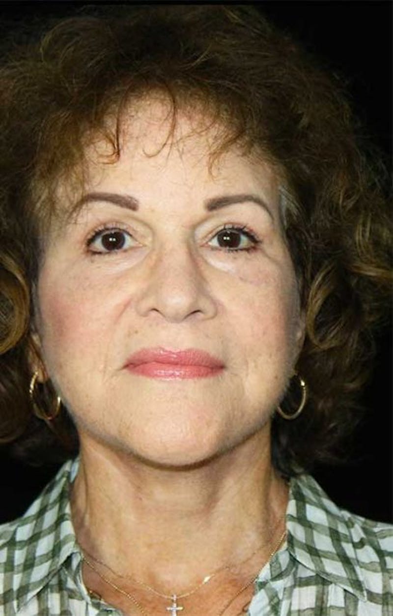 Blepharoplasty Before & After Gallery - Patient 379220 - Image 2