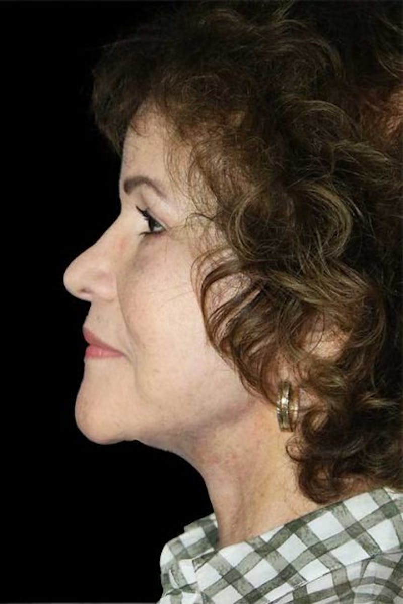 Blepharoplasty Before & After Gallery - Patient 379220 - Image 6