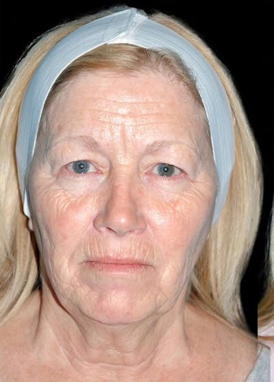 Blepharoplasty Before & After Gallery - Patient 174637 - Image 1