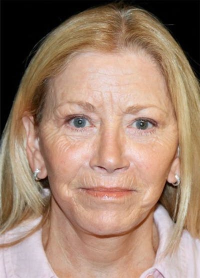 Blepharoplasty Before & After Gallery - Patient 174637 - Image 2
