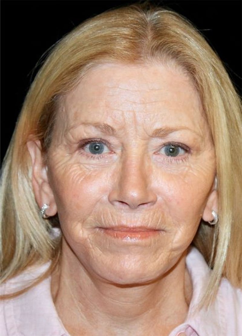 Blepharoplasty Before & After Gallery - Patient 174637 - Image 2