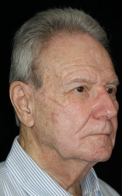 Blepharoplasty Before & After Gallery - Patient 654727 - Image 1
