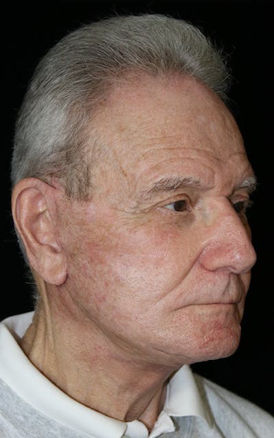 Blepharoplasty Before & After Gallery - Patient 654727 - Image 2