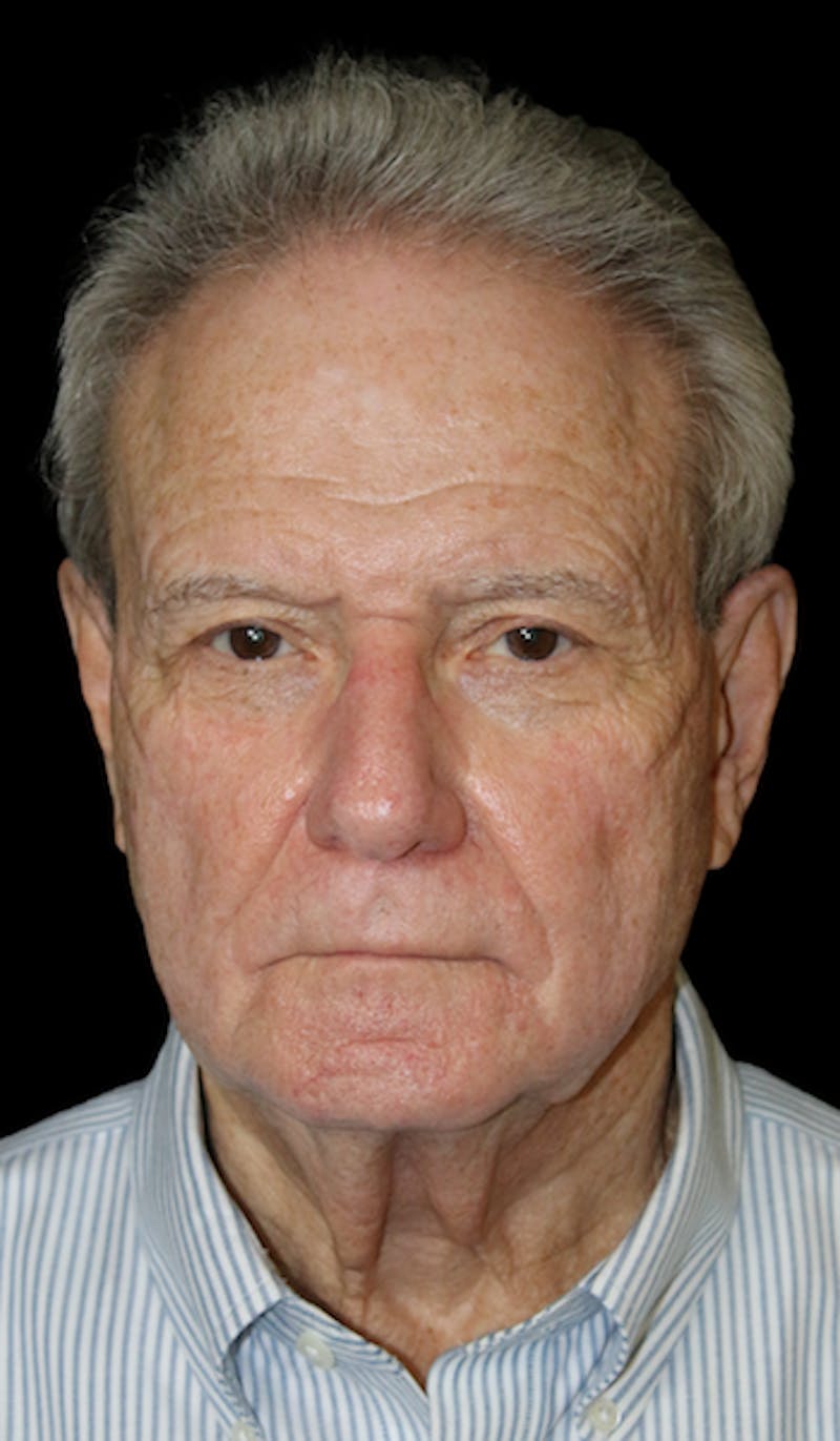 Blepharoplasty Before & After Gallery - Patient 654727 - Image 3