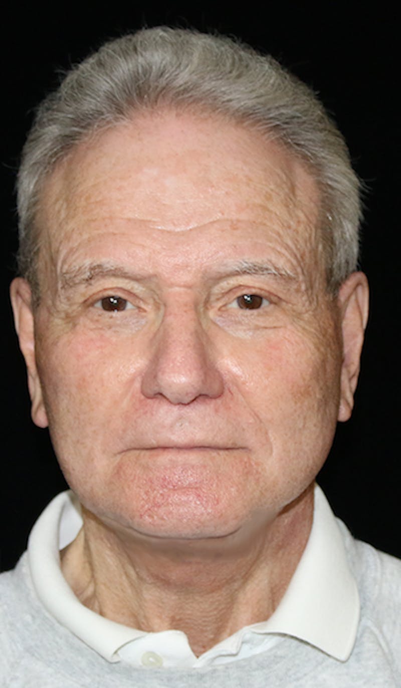 Blepharoplasty Before & After Gallery - Patient 654727 - Image 4