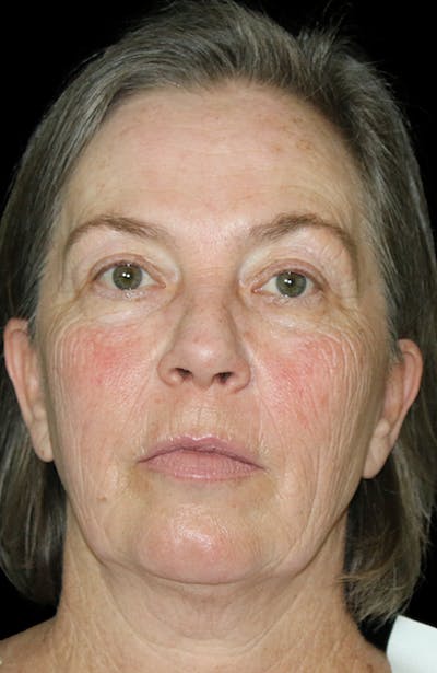 Blepharoplasty Before & After Gallery - Patient 401672 - Image 1